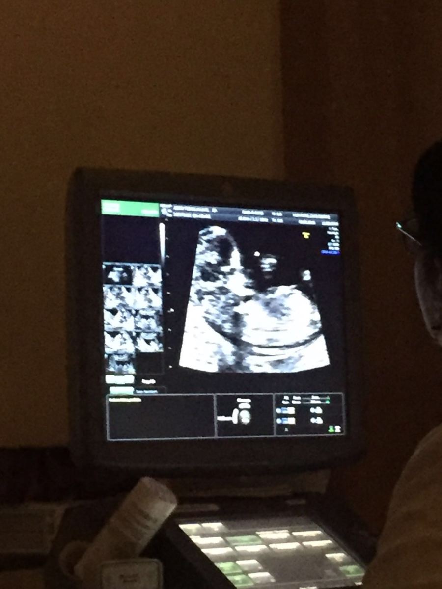 Ultrasound, OSCAR Test, fetus, baby, scan
